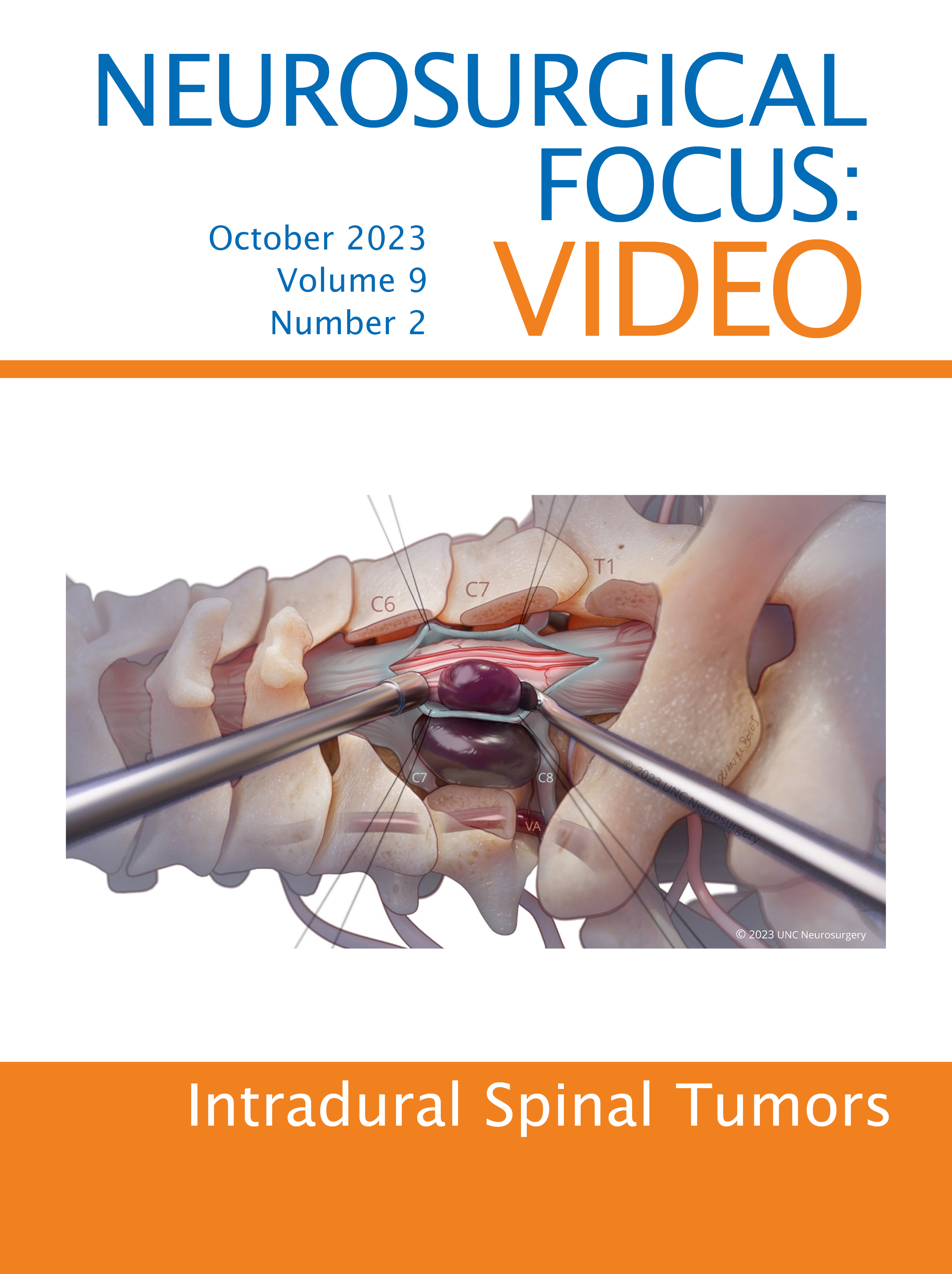 Volume 9: Issue 2 (October 2023): Intradural Spinal Tumors
